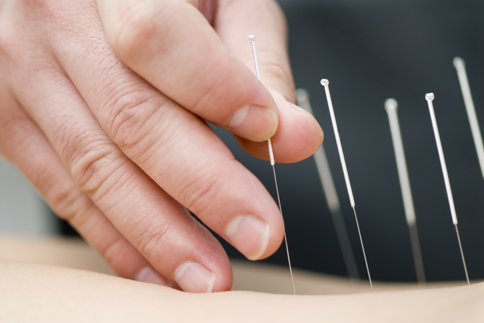Acupuncture Treatment Acupuncture Treatment