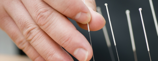 Acupuncture demonstration Acupuncture demonstration